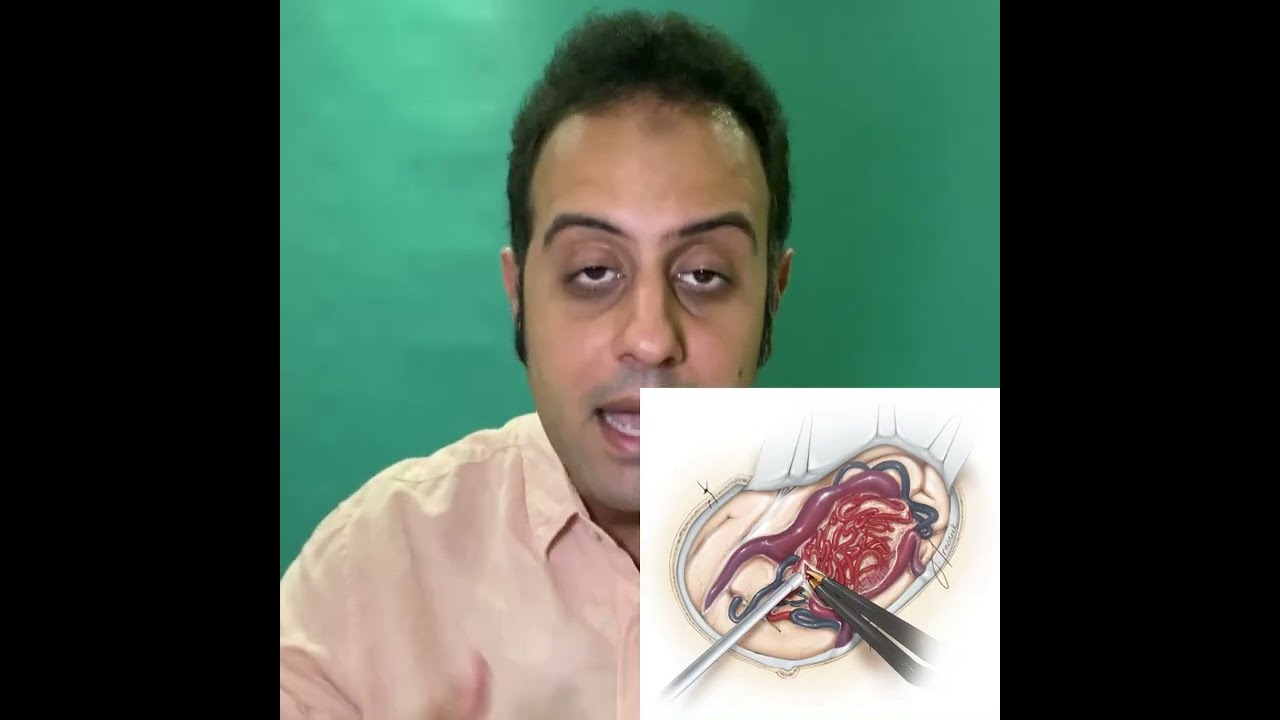 افضل طريقة لعلاج التشوه الشرياني الوريدي في المخ | د. مصطفى فريد | Brain AVM