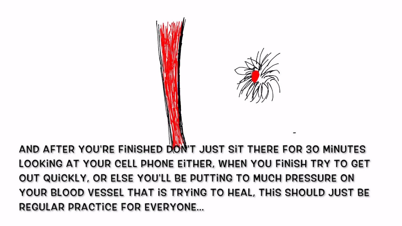 External Thrombosed Hemorrhoids Explained and How To Heal YouTube