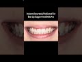 Lightforce used to be generic. Brackets used to be one-size-fits-all. Orthodontics used to ignore yo