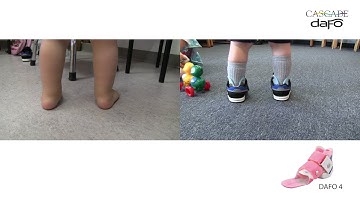 Before & After | Low Tone Pronation | DAFO 4 | Cascade Dafo