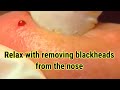 Relax with blackhead removal great share spa