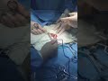手术取出假阳具震惊医护人员 手术取出假阳具震惊医护人员