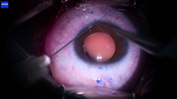 Restoring Stability: Flanged Prolene Suture in IOL Subluxation