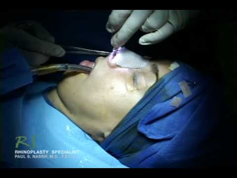 Video thumbnail: Dr. Nassif's Closed Rhinoplasty How To - Exposing Nasal Skeleton · NassifMD®