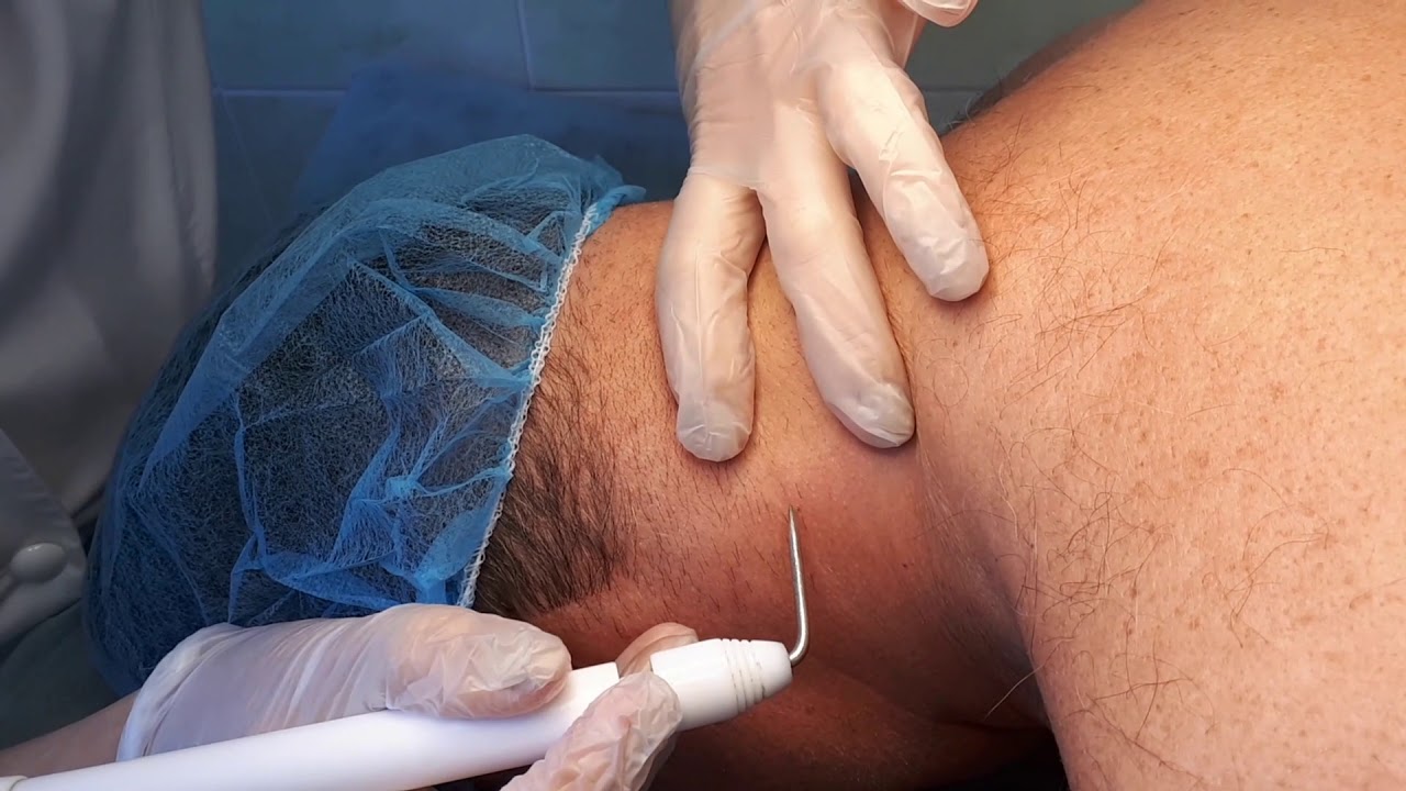 Электрокоагуляция папиллом в воротниковой зоне