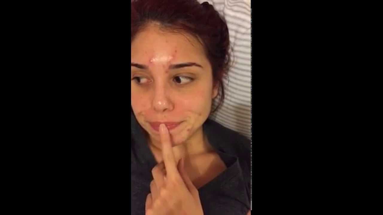 acne.org skin regimen 1st week review