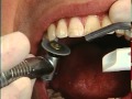 C997A - Removal of Superficial Tooth Stains