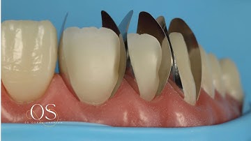 Direct veneering using composite resin with new unica proximal matrix- the simplified approach