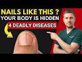 Neurologist Explains: If Your NAILS Look Like THIS After 60, Your Body Can be Hiding 4 Diseases.