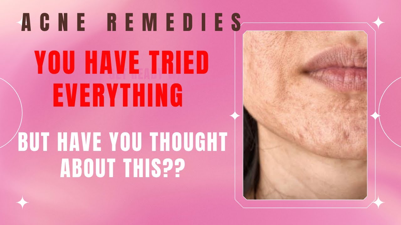 How to get rid of ACNE Naturally at home | Acne treatment | Womens ...