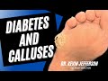 Diabetes and Calluses: Removal of Thick Hard Calluses from Diabetes