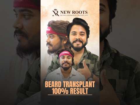 From Patchy Beard to Fuller Beard | Amazing Beard Hair Transformation #beard #shorts