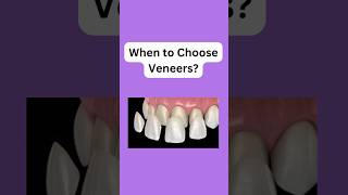 When Do You Need Dental Veneers? #dentist #veneers #dentaltips #healthysmile #whiteteeth #shorts
