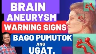 Brain Aneurysm: Warning Signs Bago Pumutok ang Ugat. -By Doc Willie Ong (Internist and Cardiologist)