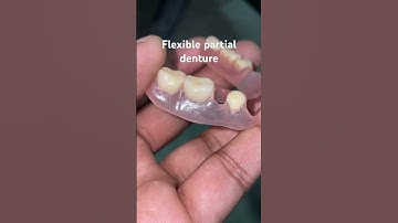 Flexible partial denture 😬😬😬#apexdental #splittooth #dentistry #partialdenture #orthodontist