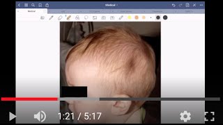 Clinical Case: child bumps head and now has a ‘dent’ in his skull