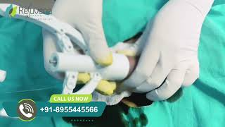 Painless Circumcision Surgery with Stapler | Tight Foreskin Treatment at Rejuvena Cosmo Care