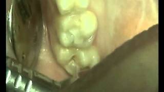 Лечение кариеса эрбиевым лазером, 18 зуб(, 2011-08-11T13:57:15.000Z)