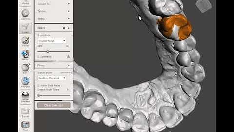 training case :virtual tooth extraction and ovate pontic site creation