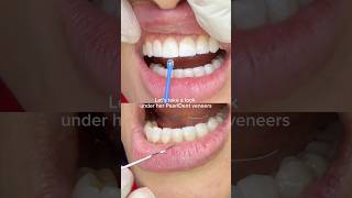 PearlDent Veneers | Smile Makeover Berlin-Charlottenburg