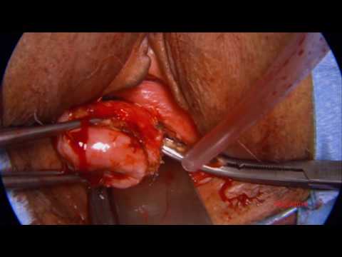 Vaginal hysterectomy, cystocele repair, McCall and perineorrhaphy.