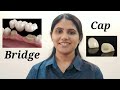 नया दांत कैसे बिठाते हैं? Tooth Cap & Bridge: Types, Procedure