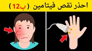 10 علامات تحذيرية أنك تعاني من نقص فيتامين ب 12| تحذير الأطباء من نقص ب 12 على حياتك!