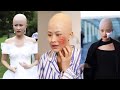 She was bullied because she was bald | The Bald Bride Short Film (Ep.03)