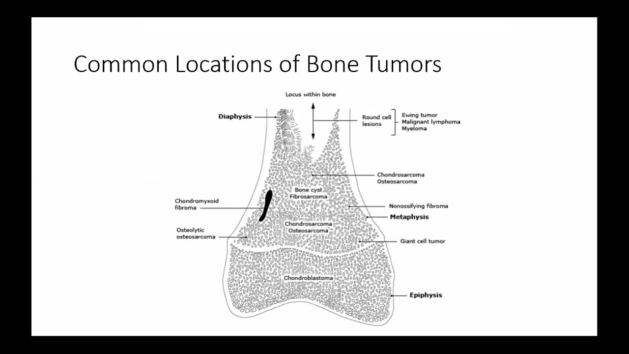 AROI WB Clinical Oncology : Bone Tumors & Soft Tissue Sarcoma