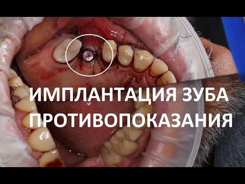 Противопоказания к имплантации зубов. Немецкая имплантология в Москве.