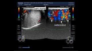 Maneuver varicocele valsalva