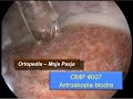 Artroskopia biodra - artroskop, przygotowanie, procedura i powikłania | OMP #007