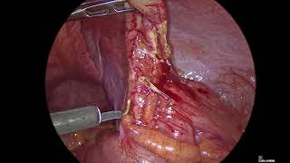 Laparoscopic Appendicectomy in a pediatric patient - Acute appendicitis with pelvic collection