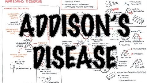 Thumbnail of Addison's Disease - Overview (clinical features, pathophysiology, investigations, treatment)