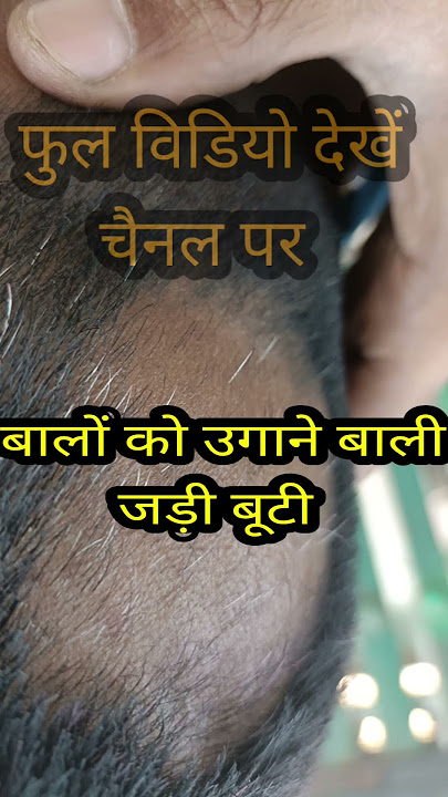 How to get rid of baldness in a week, how to get rid of baldness with onion, how to get rid of ba...