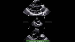 Congenitally corrected TGA 3