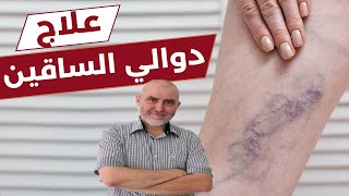 علاج طبيعي فعال لدوالي الساقين تعرف عليه الآن مع الدكتور كريم العابد العلوي 2022