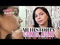 Mi historia con el ACNE - ROACCUTANE #StoryTime