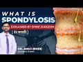 Spondylosis Explained in Marathi. #spineinjury #spondylitis #spine #spinehealth #spinesurgery 