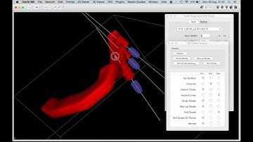 Tooth Supported Surgical Drill Guide Design with Dental3DPlugin 2.3.0