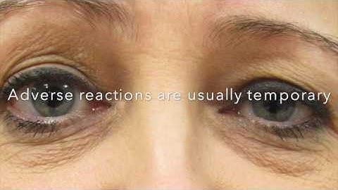 What You Need to Know About BotulinumToxin