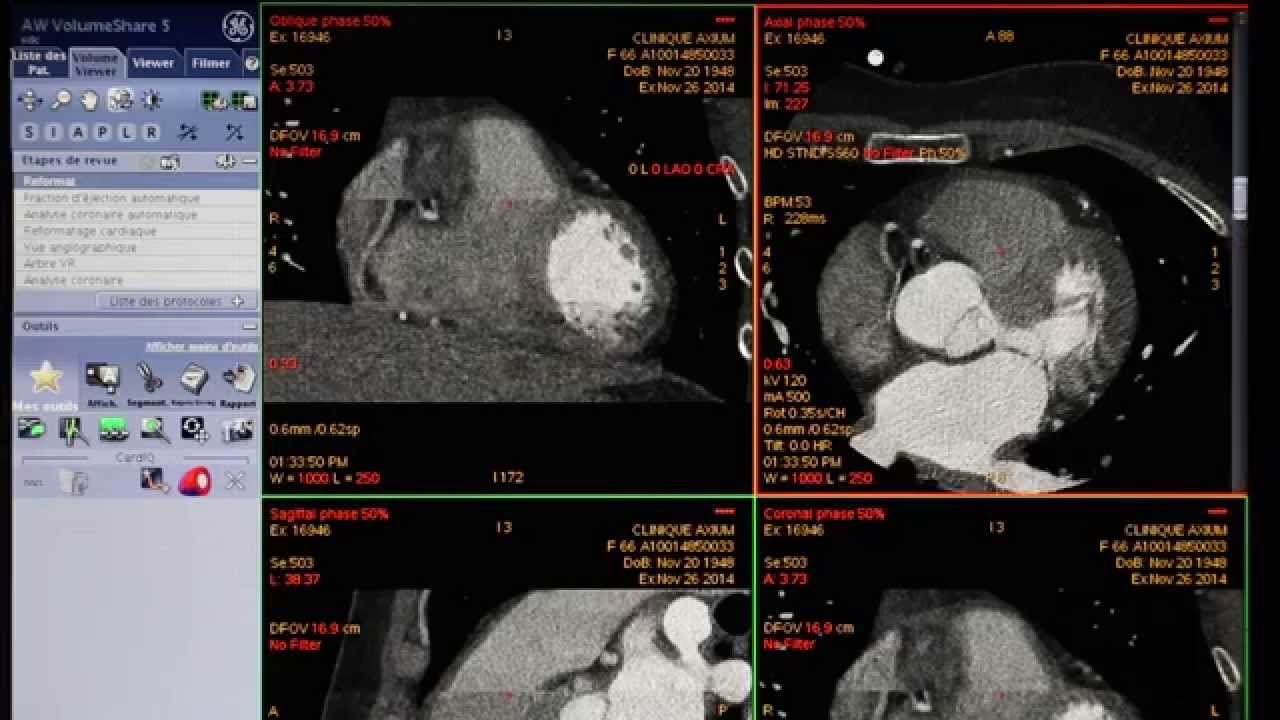 Interprétation Coroscanner STANDARD Tutoriel YouTube Interprétation Coroscanner STANDARD Tutoriel YouTube