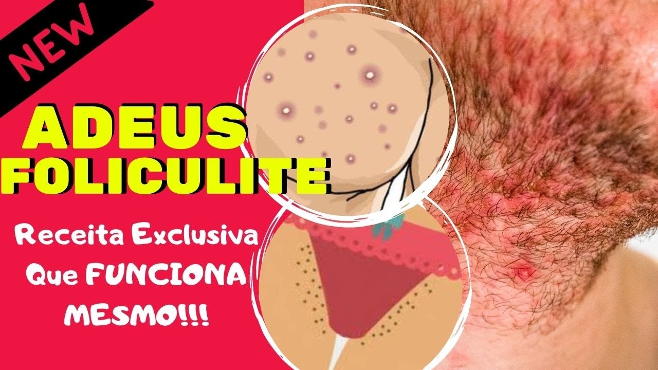 INFALÍVEL! COMO ACABAR COM A FOLICULITE!!! Por Márcia Romero - YouTube