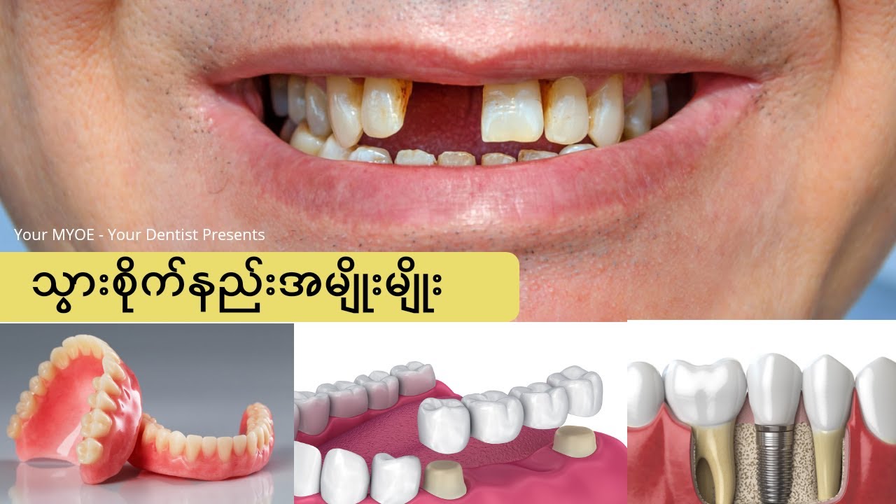 သွားစိုက်နည်းအမျိုးမျိုးအကြောင်း‌ဗဟုသုတ #YourMYOE #YourDentist