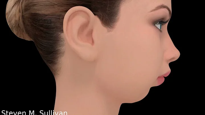 TMJ Total Joint Replacement animation | Dr. Steven...