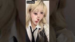 7개월 후 변화! 눈+코+얼굴지방흡입 수술 후 공개!
