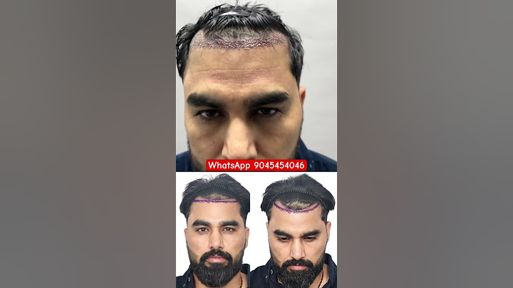 YouTuber Armaan Malik Hair Transplant Result #haircare #armaanmalik #hairtransplant