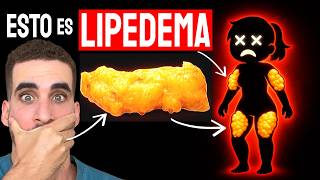 Cómo eliminar la Celulitis y el Lipedema Lipedema Tratamiento