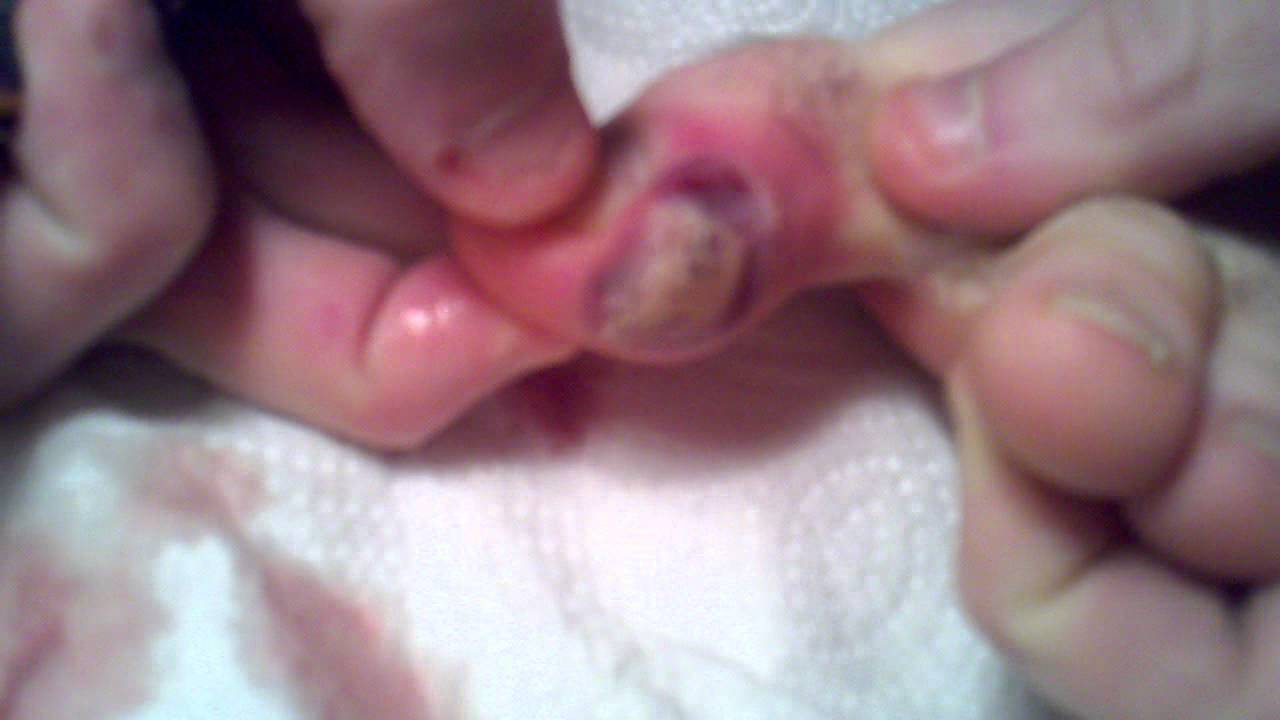 Part 2 GIANT PIMPLE CYST POP ON TOE PART 2 - The Popping - YouTube