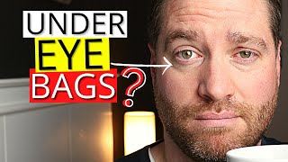Dark Under EYE BAGS!? - Eye Doc Explains Causes And Treatments For Dark Circle Under Eye Bags!